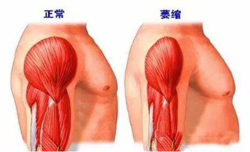 肯尼迪病(KD)