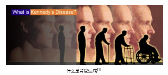 【罕見病并不罕見】肯尼迪病(KD)—漫長的“漸凍癥”